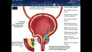 Management of Urinary Bladder Carcinoma: High-Yield Summary (Bailey & Love)