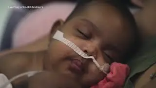 Parents of conjoined twins thank Cook Children's after a successful separation surgery