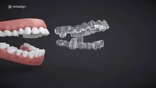 Unbraced | Ortho Education With Invisalign
