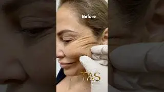 55 years old to back 30 years old 🧜&zwj;♀️ #facelift