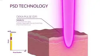 SmartXide Punto - Avanzada Tecnolog&iacute;a de Laser CO2 y Tratamiento CoolPeel (R)