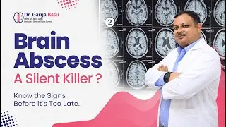Brain Abscess Explained | Causes, Symptoms & Treatment | Dr Garga Basu - Brain & Spine Surgeon