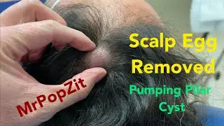 &ldquo;Pumping Pilar&rdquo; scalp egg removal. Benign growth from hair follicle. Follow up at end, heals great!
