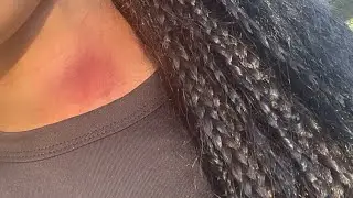 HICKEY PRANK ON MOM!!!(MUST WATCH 🤣🤣)