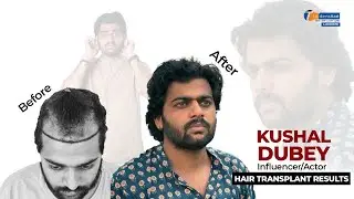 Actor & Content Creator Kushal Dubey Shares His Hair Transplant Journey | La Densitae Lucknow