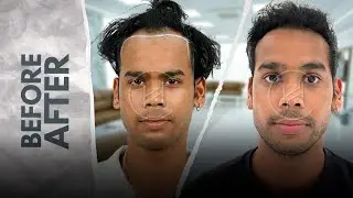 18+ Month Hair Transplant Before & After | Real Long-Term Result