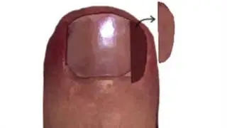 Marshall Lukoff Ingrown Toenails