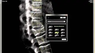 Optasia SpineAnalyzer - Demo on VFA images