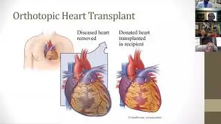 Heart Transplant