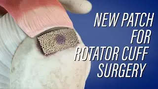 BioEnthesis: a new patch for rotator cuff surgery
