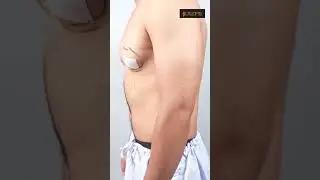 Gynecomastia result