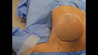 Mastopexia MeshLift