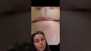 POV: you have chin bumps and acne