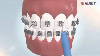 Ortho Solutions - Yes Bracket