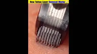 How tattoo laser removal works 🤯 #telugufacts #telugu #shorts #viralnews #viral