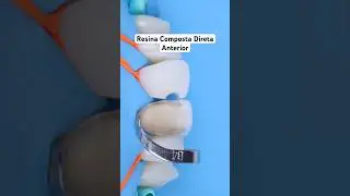Composite ✨ #dentistas #dentista #odonto #faceta #dentist #dentistry #dentistas #odontolog&iacute;a