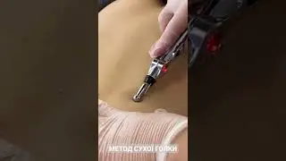 Метод сухої голки для відновлення функцій опорно-рухового апарату.