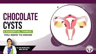 Chocolate Cysts : 5 Essential Things you need to Know!