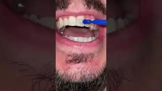 Фтористый лак для зубов