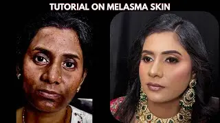 How to Cover Melasma Naturally | Pigmentation-Safe Makeup Tutorial
