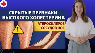 Ваши ноги «кричат» о холестерине! Самодиагностика за 5 минут