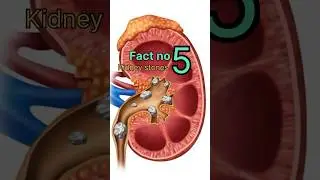 Kidney stone symptoms #kidneystone #healthvideos #pain #kidney disease y