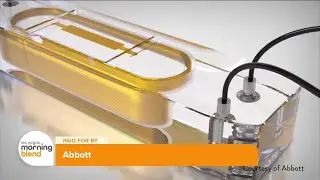 Breakthrough Heart Failure Technology: How Abbott&rsquo;s CardioMEMS Helps Patients Live Freely