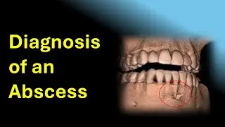 How a dental cone beam helped diagnose an abscess