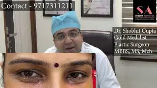 What is Xanthelasma Removal Treatment | Dr. Shobhit Gupta Xanthelasma Laser Removal Before and After