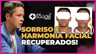 Corrigindo a Hiperplasia Condilar: antes e depois da cirurgia ortogn&aacute;tica