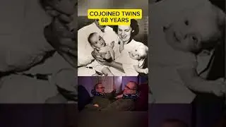 Conjoined Twins: Born Physically Connected 😱#didyouknow #facts #trending