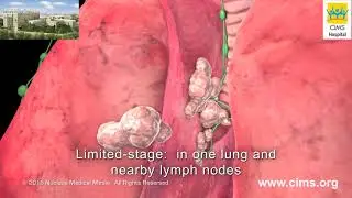 Small Cell Lung Cancer Staging &ndash; CIMS Hospital