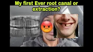 My first ever root canal or extraction?