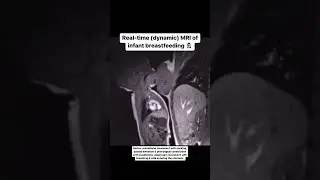 Real-time (dynamic) MRI of infant breastfeeding