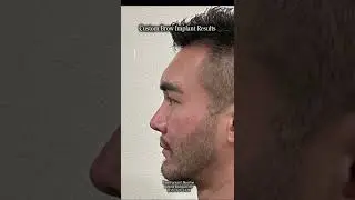 Brow Bone Augmentation| Facial Implants| Before and After