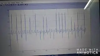 Plotting of ECG signal on Matlab using AD8232