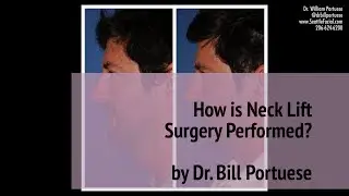 How is Neck Lift Surgery Performed? (Turkey Neck) by Dr. William Portuese  👨&zwj;⚕️ | Seattle WA