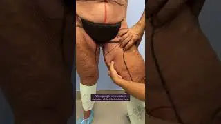Part 1: Lower Body Lift, Reducing Hip Width & Vertical Thighplasty
