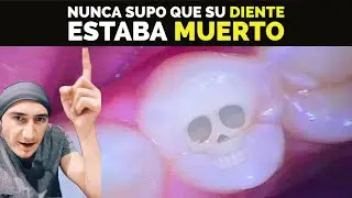 Ten&iacute;a un diente muerto y nunca se enter&oacute;. Todo por NO usar hilo dental.