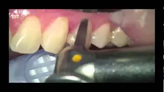 Dental Restorations with Renamel Flowable Microfill.flv