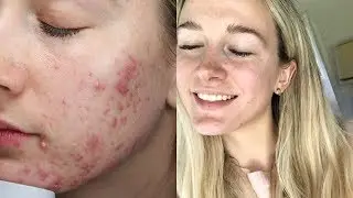My Cystic Acne Story | Part One: Treatments + Lifestyle Changes