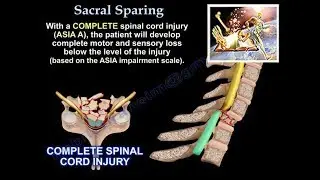 Spinal cord injury ,Sacral Sparing - Everything You Need To Know - Dr. Nabil Ebraheim