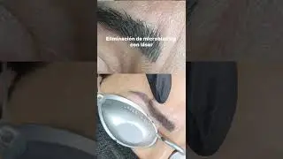 Eliminar microblading #cejas #borrarcejas #eliminarmicroblading #microblading