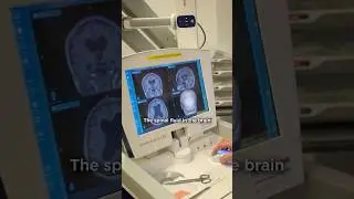 Researchers show brain shunts significantly benefit older adults with hydrocephalus