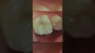 Vital pulp Therapy for Deep Carious Lesion in upper molar using theracal and Composite #الكربولة