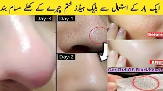 Remove blackheads and Whiteheads from nose and face naturally at home/open pores home remedy