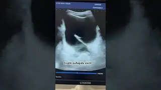 Siydik pufagida stent. Стен в мочевом пузыре.