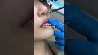 #lipfiller #lips #lipart #filler #nonsurgicaltreatment #beauty #medspa #shortsfeed #ytshort