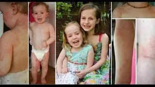 Eczema-free: Long-term Results of the Aron Regimen