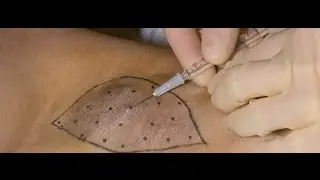 botox for underarm sweating
